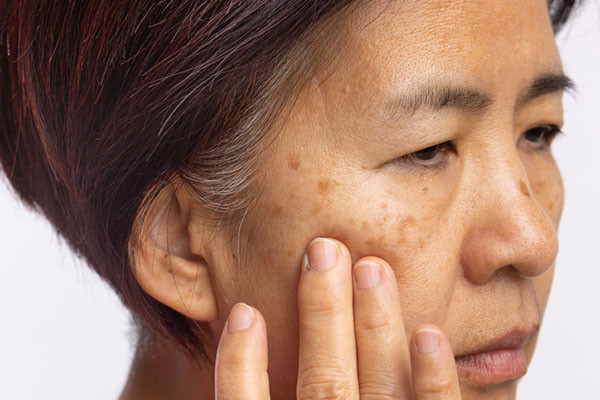 You are currently viewing Melasma: What are the best treatments?